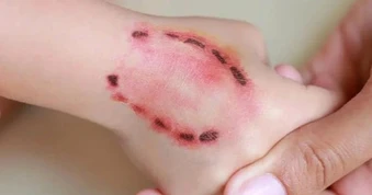 Bé trai bị chó becgie cắn phải nhập viện cấp cứu ở Tây Ninh