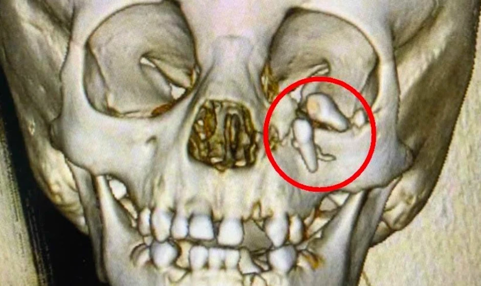 Bé trai bị chó nhà tấn công, hai răng hàm lọt vào hốc mắt Bé trai bị chó nhà tấn công, hai răng hàm lọt vào hốc mắt