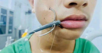 Bé trai bị lưỡi câu móc sâu vào mặt