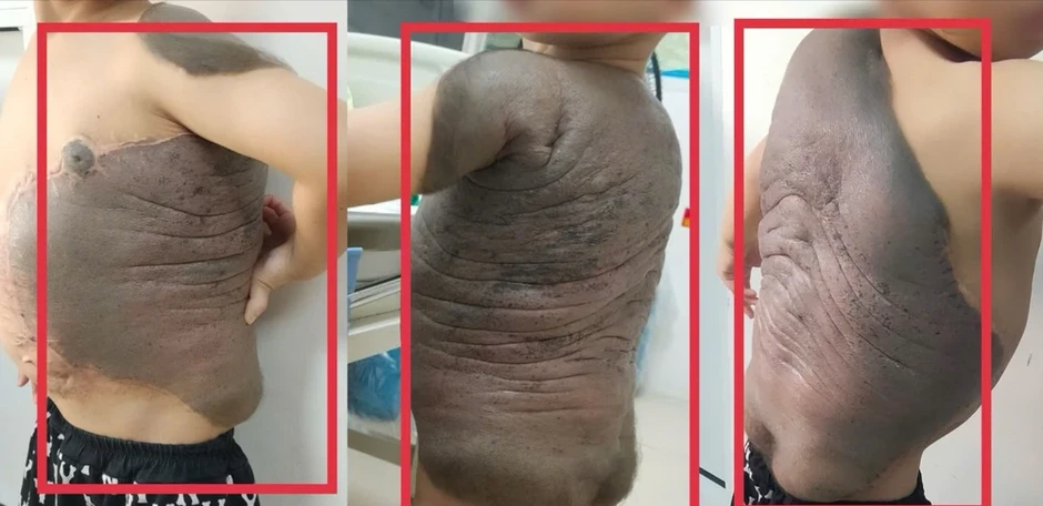 Bé trai mang khối u như mai rùa lần đầu đứng thẳng sau 6 lần phẫu thuật Bé trai mang khối u như mai rùa lần đầu đứng thẳng sau 6 lần phẫu thuật