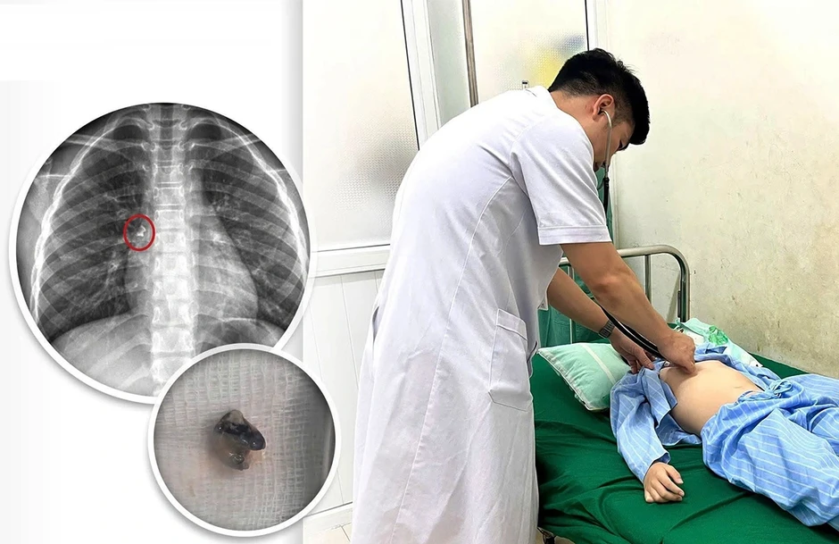 Bé trai nhập viện cấp cứu vì tình huống hi hữu khi nhổ răng