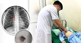 Bé trai nhập viện cấp cứu vì tình huống hi hữu khi nhổ răng
