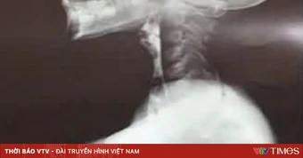 Bé trai nuốt nghẹn 3 năm vì bệnh hiếm gặp