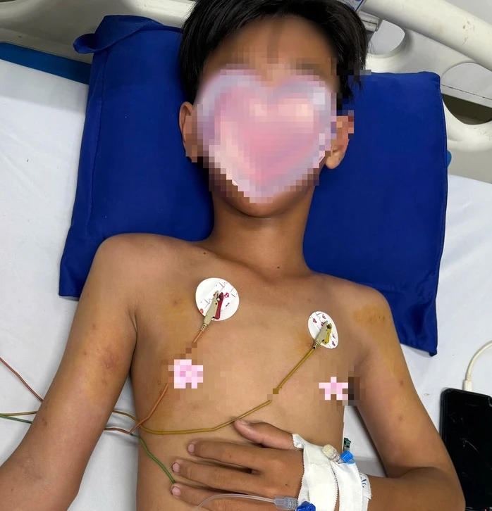 Bé trai ở Cà Mau bị ong vò vẽ đốt hơn 50 vết Bé trai ở Cà Mau bị ong vò vẽ đốt hơn 50 vết