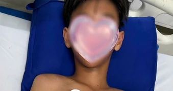 Bé trai ở Cà Mau bị ong vò vẽ đốt hơn 50 vết