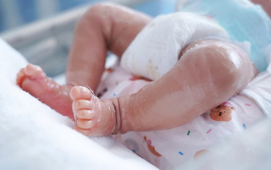 Bé trai sơ sinh da như vảy cá, mi mắt lộn ngược Bé trai sơ sinh da như vảy cá, mi mắt lộn ngược