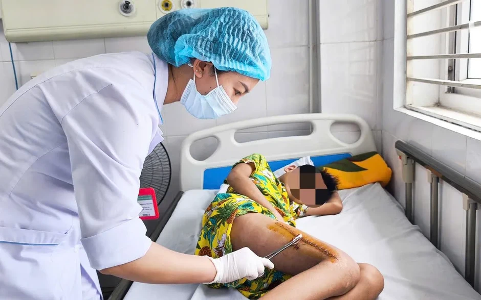 Bé trai suýt mất chân vì tụ cầu vàng phá hủy xương đùi Bé trai suýt mất chân vì tụ cầu vàng phá hủy xương đùi