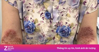 Bệnh da hiếm khiến người phụ nữ lở loét khắp các nếp gấp