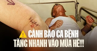 Bệnh dại: đã có 13 ca không qua khỏi chỉ trong 3 tháng đầu năm: Bác sĩ Bệnh viện Bạch Mai cảnh báo khẩn