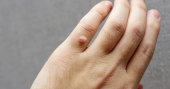 Bệnh hạt cơm lây như thế nào và nguy hiểm ra sao?