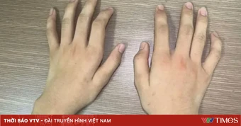 Bệnh Hirayama - nguyên nhân hiếm gặp gây teo cơ bàn tay ở người trẻ