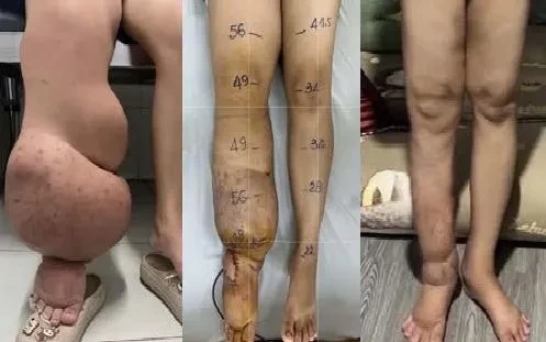 Bệnh nhân phù bạch mạch cải thiện rõ sau ghép hạch bạch huyết Bệnh nhân phù bạch mạch cải thiện rõ sau ghép hạch bạch huyết
