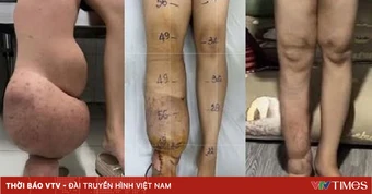 Bệnh nhân phù bạch mạch cải thiện rõ sau ghép hạch bạch huyết