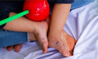Bệnh tay chân miệng có vaccine chưa? - Báo TinVina