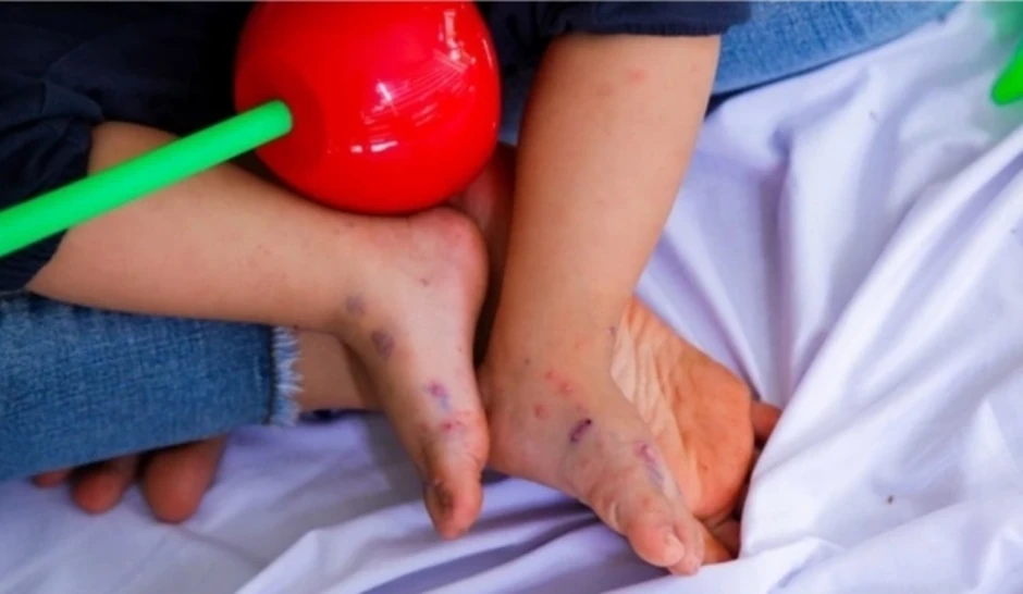 Bệnh tay chân miệng có vaccine chưa? - Báo TinVina Bệnh tay chân miệng có vaccine chưa? - Báo TinVina