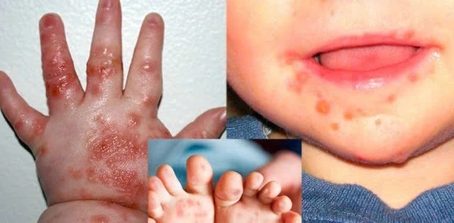Bệnh tay chân miệng: Số ca bệnh nặng có thể tiếp tục gia tăng