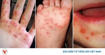 Bệnh tay chân miệng: Số ca bệnh nặng có thể tiếp tục gia tăng