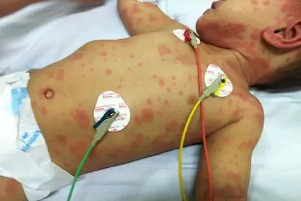 Bệnh viêm não mô cầu gia tăng: giám sát chặt chẽ, hạn chế lây lan Bệnh viêm não mô cầu gia tăng: giám sát chặt chẽ, hạn chế lây lan
