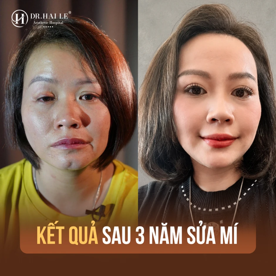 Bệnh viện Hải Lê và hành trình 9 năm đồng hành cùng những ca mí lỗi, mí hỏng phức tạp