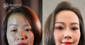 Bệnh viện Hải Lê và hành trình 9 năm đồng hành cùng những ca mí lỗi, mí hỏng phức tạp