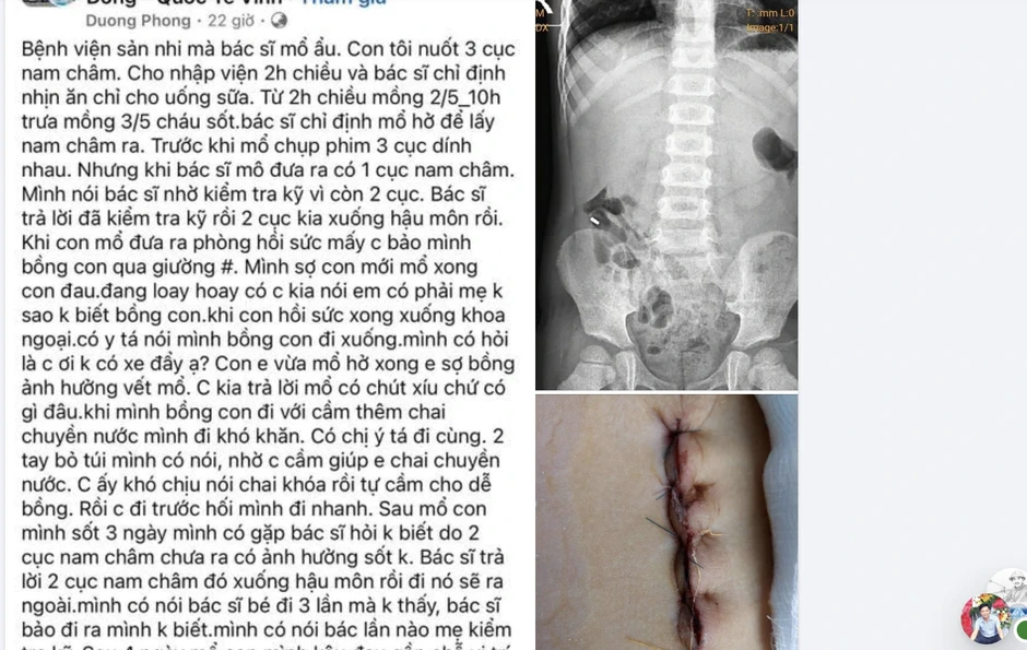 Bệnh viện lên tiếng vụ bệnh nhi bị 'bỏ sót' nam châm khi mổ Bệnh viện lên tiếng vụ bệnh nhi bị 'bỏ sót' nam châm khi mổ
