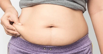 Béo phì không chỉ do 'ăn nhiều - ít vận động'