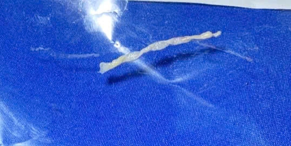 Bị sán nhái dài 7 cm ký sinh dù không ăn đồ tái, sống Bị sán nhái dài 7 cm ký sinh dù không ăn đồ tái, sống