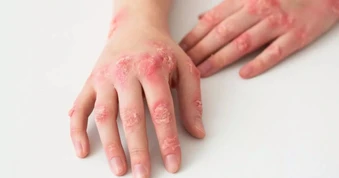 Biểu hiện phức tạp, bệnh nhân lupus ban đỏ mất hàng năm mới được chẩn đoán
