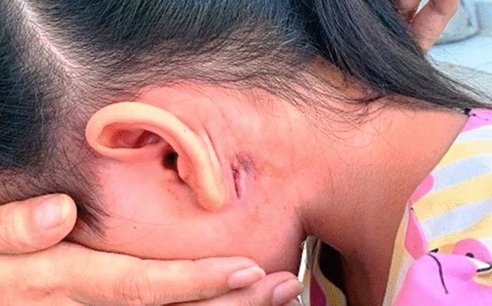 Bộ Y tế nói gì về bệnh "sốt đất" (Whitmore) sau 23 ca tử vong ở Thái Lan?