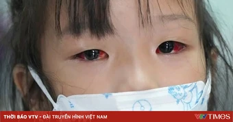 Bộ Y tế thông tin về bệnh do virus Adeno và bệnh đau mắt đỏ
