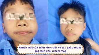 Bóc tách thành công khối u lớn phá hủy xương hàm cho bé trai 7 tuổi