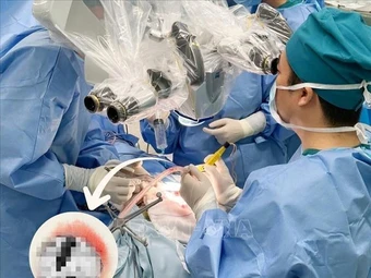 Bóc thành công khối u não xuất huyết lớn cho trẻ sơ sinh