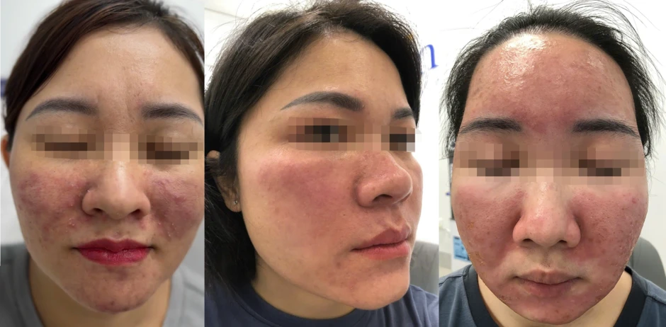 BS.CKII Nguyễn Tiến Thành: Chuyên gia điều trị biến chứng da