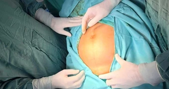 Bụng to nhanh bất thường, người phụ nữ phát hiện khối u tử cung nặng 3kg