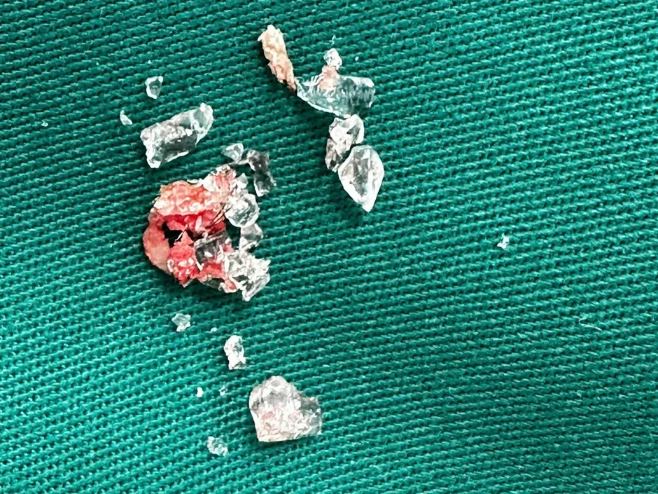 Ca cấp cứu đa chấn thương nguy kịch ngay trong đêm trực đầu tiên tại Bệnh viện Hữu nghị Việt Đức cơ sở Ninh Bình