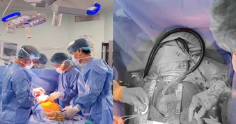 Ca cấy ghép thiết bị hỗ trợ tim CorHeart 6 đầu tiên tại Việt Nam
