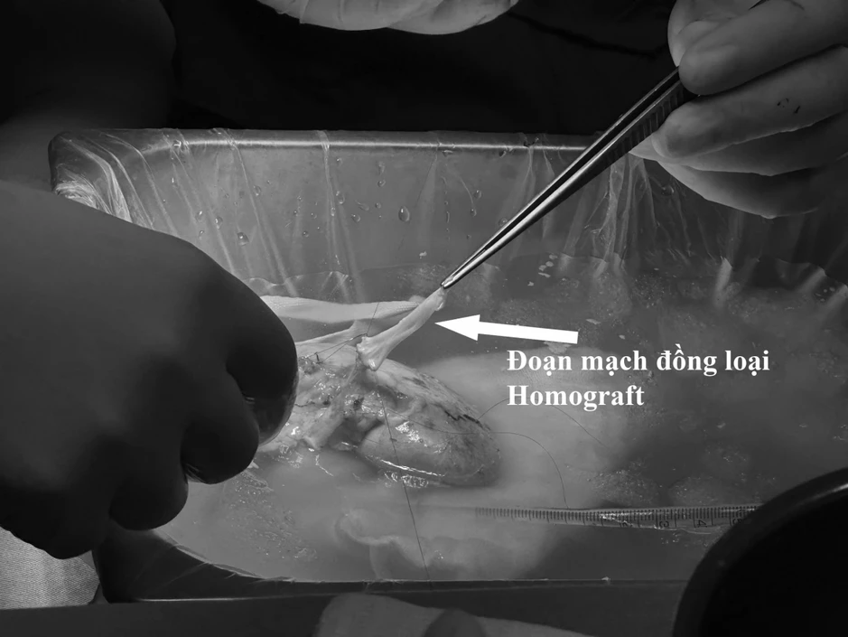 Ca ghép thận thứ 8 đặc biệt tại Bệnh viện Việt Nam-Thụy Điển Uông Bí đã xuất viện Ca ghép thận thứ 8 đặc biệt tại Bệnh viện Việt Nam-Thụy Điển Uông Bí đã xuất viện