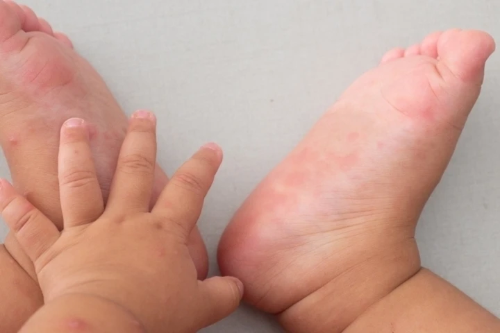 Ca mắc tay chân miệng tăng, chuyên gia khuyến cáo '3 sạch' để phòng bệnh Ca mắc tay chân miệng tăng, chuyên gia khuyến cáo '3 sạch' để phòng bệnh