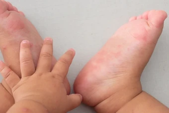 Ca mắc tay chân miệng tăng, chuyên gia khuyến cáo '3 sạch' để phòng bệnh