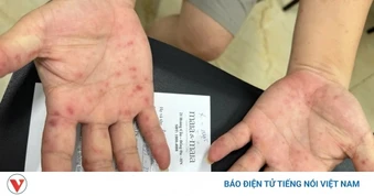 Ca mắc tay chân miệng tăng gấp 5 lần, 92% tập trung ở trẻ mầm non