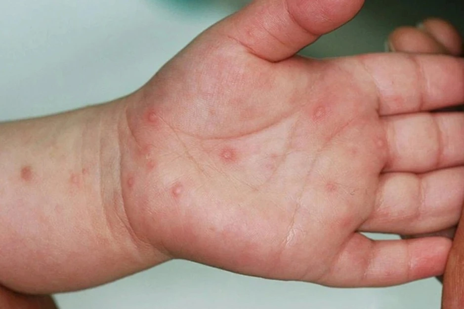 Cà Mau: Bé 3 tuổi tử vong do mắc bệnh tay chân miệng Cà Mau: Bé 3 tuổi tử vong do mắc bệnh tay chân miệng
