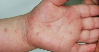 Cà Mau: Bé 3 tuổi tử vong do mắc bệnh tay chân miệng