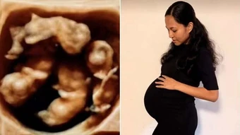 Ca sinh 4 cùng trứng tự nhiên, tỷ lệ 1 trên 15 triệu