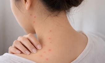 Các giai đoạn sốt xuất huyết