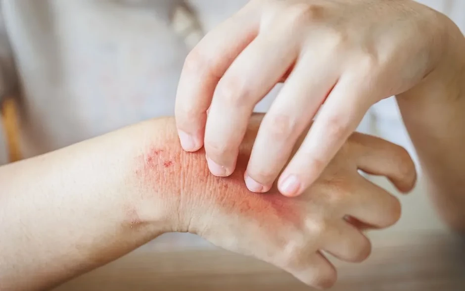 Cách nhận biết và phòng tránh bệnh da thường gặp mùa hè Cách nhận biết và phòng tránh bệnh da thường gặp mùa hè