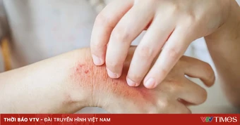 Cách nhận biết và phòng tránh bệnh da thường gặp mùa hè