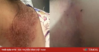 Cải thiện chất lượng sống cho người mắc bệnh Hailey-Hailey