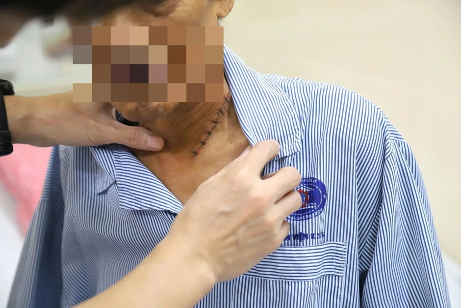 Cảm giác nuốt nghẹn khi ăn, người đàn ông mắc ung thư thực quản Cảm giác nuốt nghẹn khi ăn, người đàn ông mắc ung thư thực quản