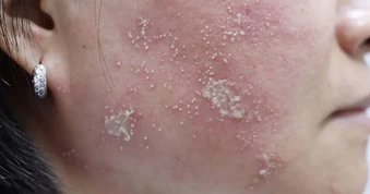 Cẩn thận viêm da do kiến ba khoang