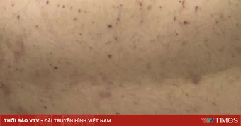 Cần Thơ ghi nhận ca mắc não mô cầu type B biến chứng nặng